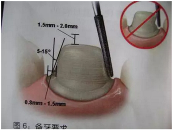 醫(yī)生，我的烤瓷牙上有個黑線怎么回事？