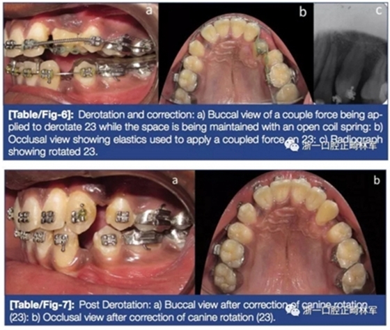 文獻優秀正畸病例賞析--牙周加速成骨正畸（PAOO）輔助的腭側埋伏尖牙牽引矯治及5年跟蹤隨訪