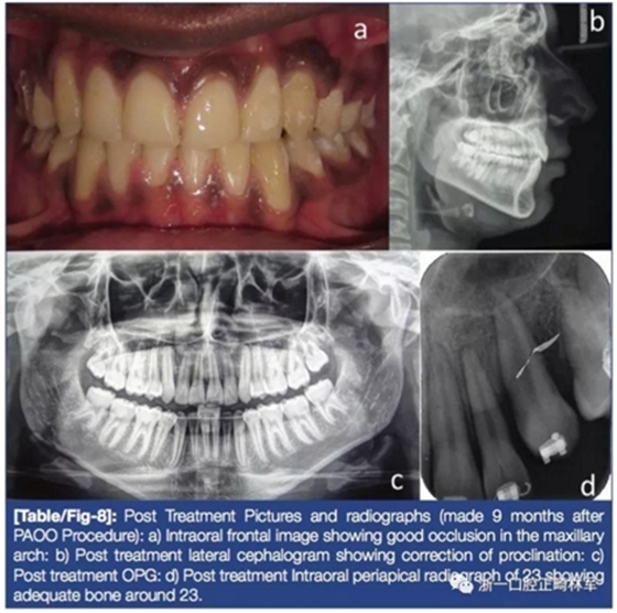 文獻優秀正畸病例賞析--牙周加速成骨正畸（PAOO）輔助的腭側埋伏尖牙牽引矯治及5年跟蹤隨訪