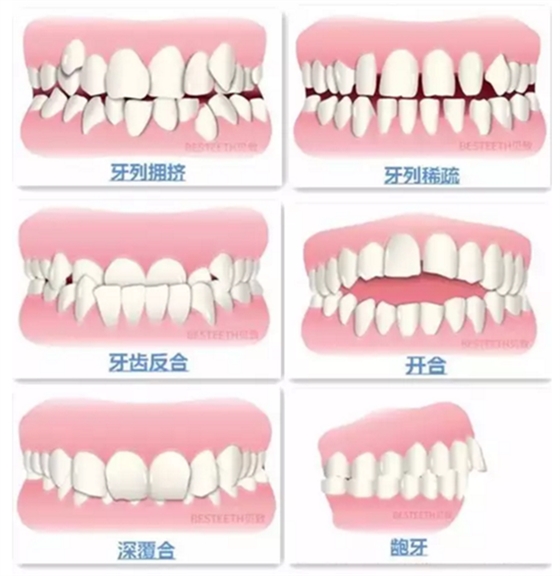 【口腔科普】關(guān)于矯牙前、中、后需要注意的問題，了解一下？