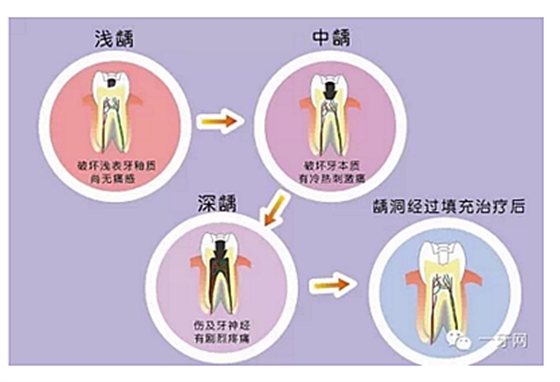 詳解牙疼的原因分幾種？