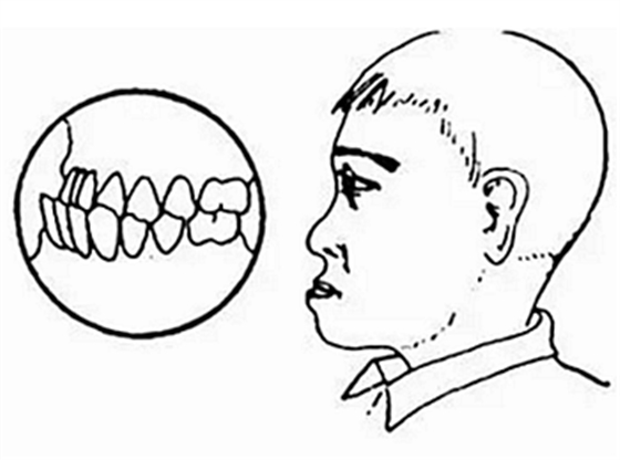 孩子怎么會(huì)長(zhǎng)出雙排牙？