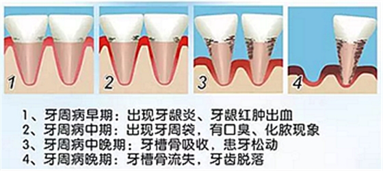 牙周病發展過程