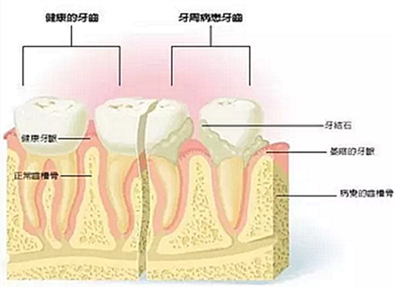 牙周病發展過程