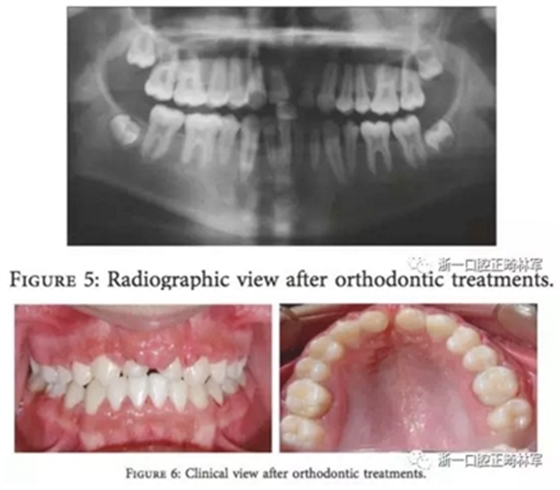文獻優秀正畸病例賞析--上頜中切牙區受傷后自體牙移植及正畸治療13年隨訪病例