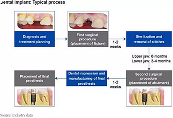 種植體，在全球牙科設備市場的變化！