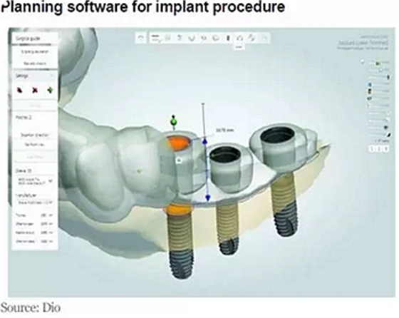 種植體，在全球牙科設備市場的變化！