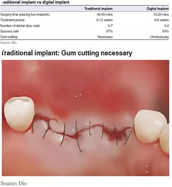 種植體，在全球牙科設備市場的變化！
