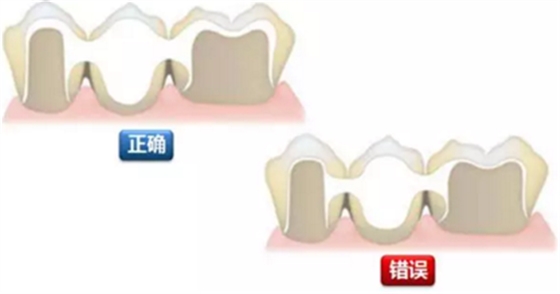 全鋯牙冠裂原因分析—操作流程工藝以及患者日常使用