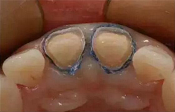 雙線排齦在口腔臨床冠修復上的應用