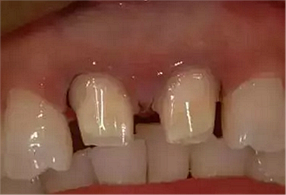 雙線排齦在口腔臨床冠修復上的應用