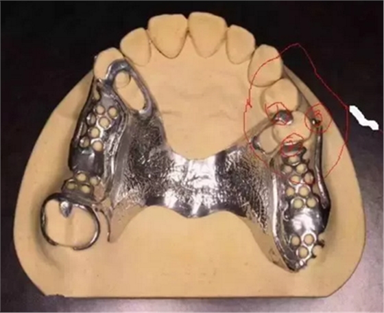 活動義齒修復，要懂的鋼托設計
