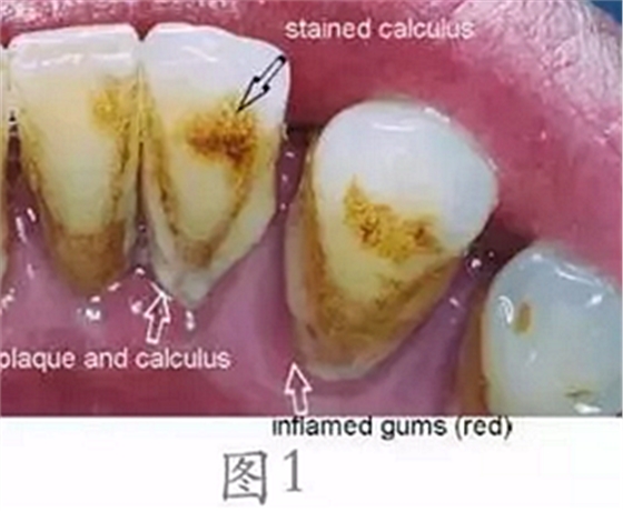 	 牙齦碰不得，一碰就出血。這是咋回事？