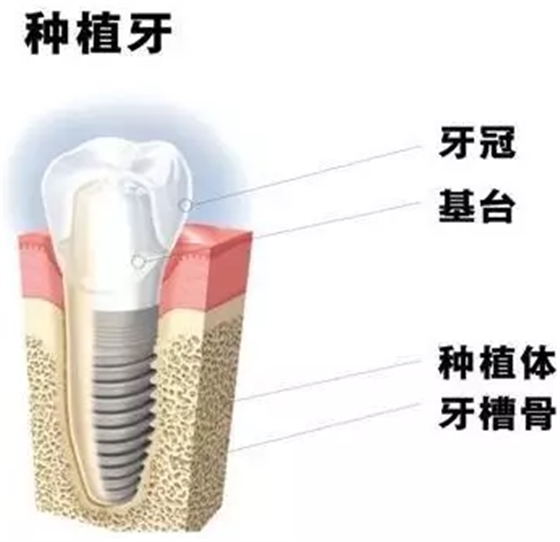 種植牙會松動的原因是什么？