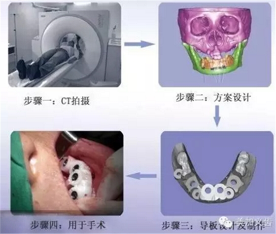 牙技術丨牙科種植導板在臨床中的應用