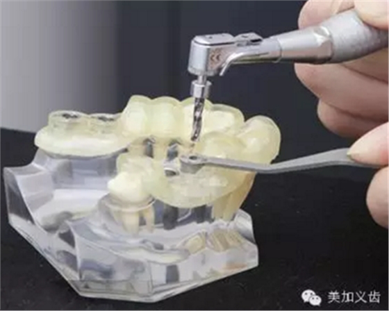 牙技術丨牙科種植導板在臨床中的應用
