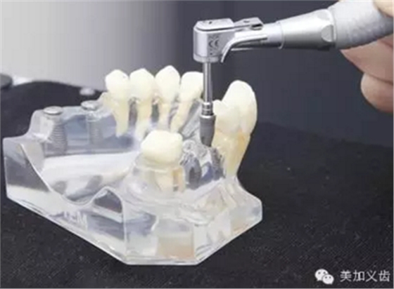 牙技術丨牙科種植導板在臨床中的應用