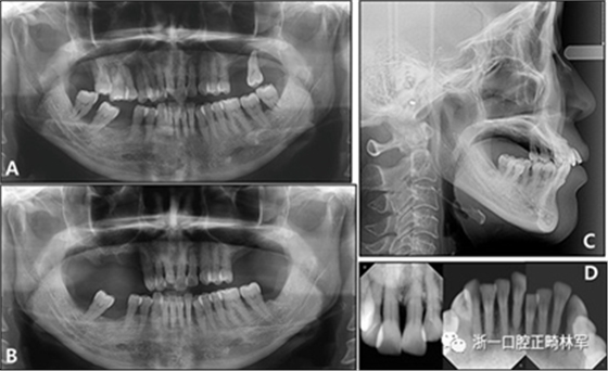 文獻優秀正畸病例賞析--多顆牙齒缺失的牙周炎患者的跨學科綜合治療