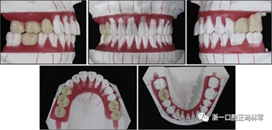 文獻優秀正畸病例賞析--多顆牙齒缺失的牙周炎患者的跨學科綜合治療