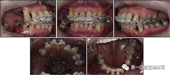 文獻優秀正畸病例賞析--多顆牙齒缺失的牙周炎患者的跨學科綜合治療