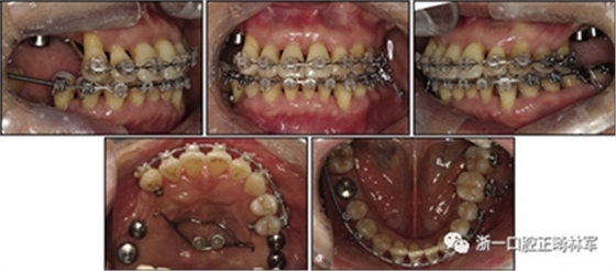 文獻優秀正畸病例賞析--多顆牙齒缺失的牙周炎患者的跨學科綜合治療