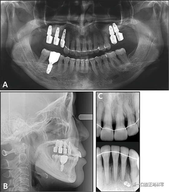 文獻優秀正畸病例賞析--多顆牙齒缺失的牙周炎患者的跨學科綜合治療