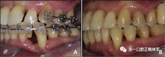 文獻優秀正畸病例賞析--多顆牙齒缺失的牙周炎患者的跨學科綜合治療