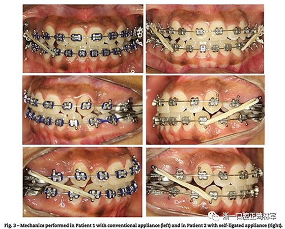 文獻優秀正畸病例賞析--同卵雙胞胎使用自鎖托槽和傳統托槽正畸治療比較