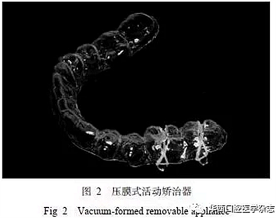 利用壓膜式活動矯治器壓入下頜第一、第二磨牙1例