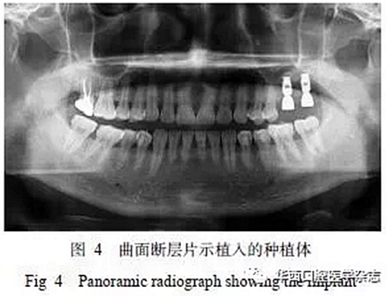 利用壓膜式活動矯治器壓入下頜第一、第二磨牙1例