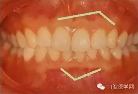 牙床骨質突起的原因和處理措施