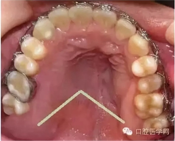 牙床骨質突起的原因和處理措施