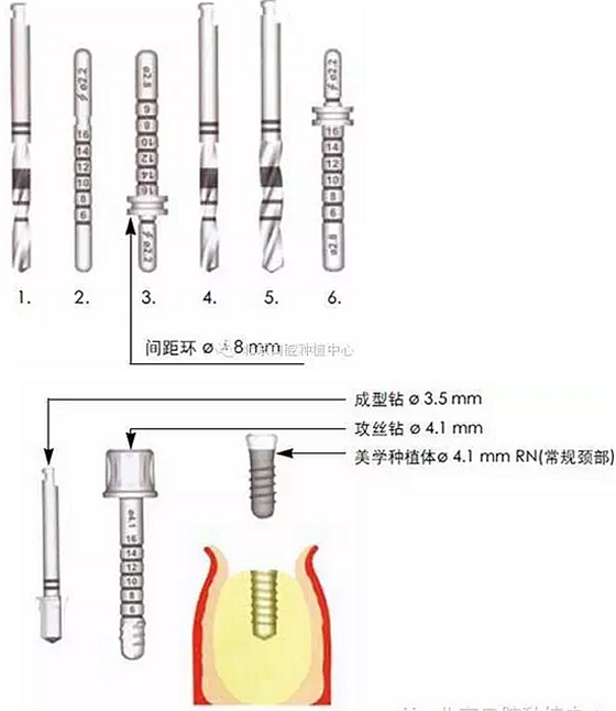 Sraumann種植系統外科操作流程