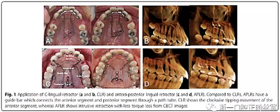 正畸文獻閱讀--用舌側滑動牽引系統控制前牙區段：初步的CBCT研究