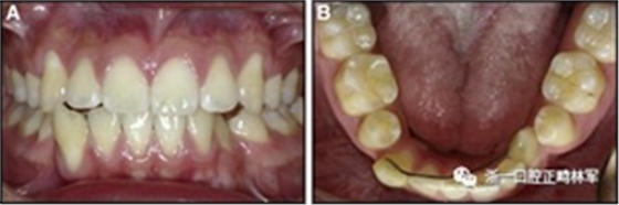 正畸文獻閱讀--固定舌側保持器作用下意外的牙齒移動