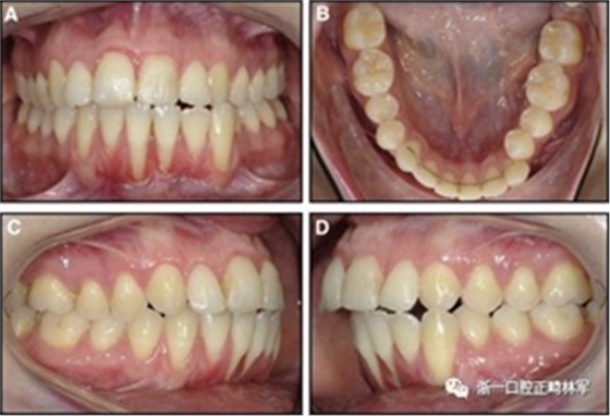 正畸文獻閱讀--固定舌側保持器作用下意外的牙齒移動