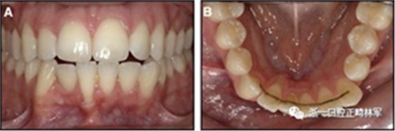 正畸文獻閱讀--固定舌側保持器作用下意外的牙齒移動