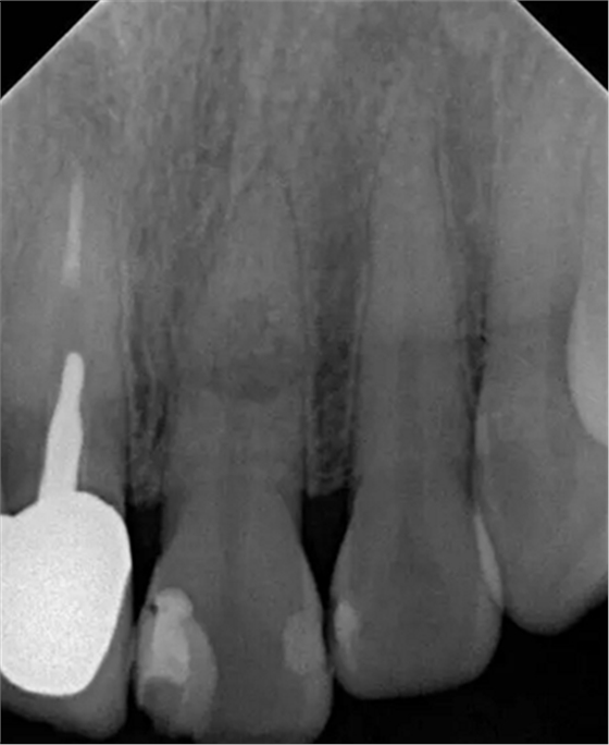伴隨根管內鈣化物形成牙根內吸收治療1例