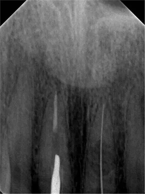 伴隨根管內鈣化物形成牙根內吸收治療1例