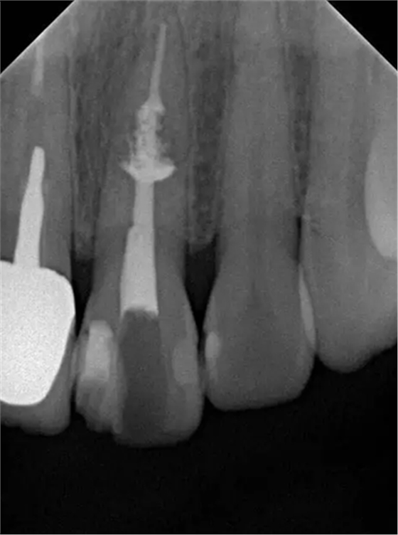 伴隨根管內鈣化物形成牙根內吸收治療1例