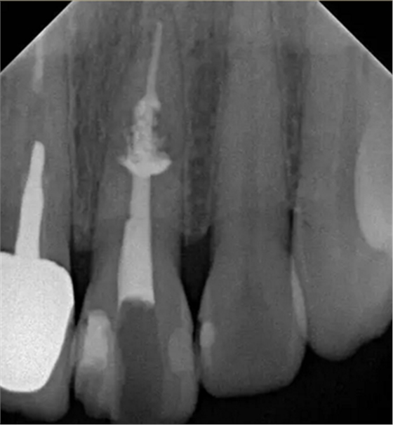 伴隨根管內鈣化物形成牙根內吸收治療1例