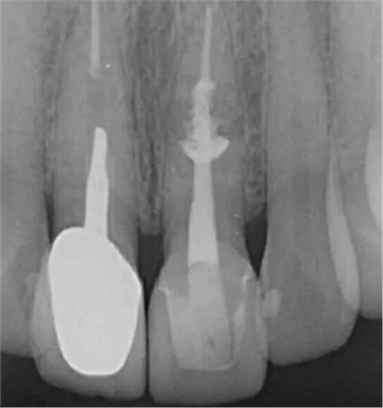 伴隨根管內鈣化物形成牙根內吸收治療1例