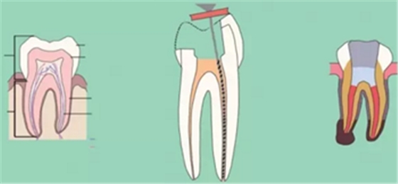知識分享：根管治療的標準步驟