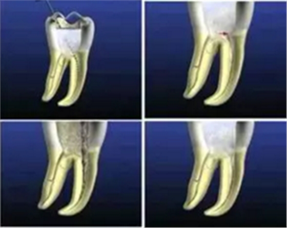 知識分享：根管治療的標準步驟
