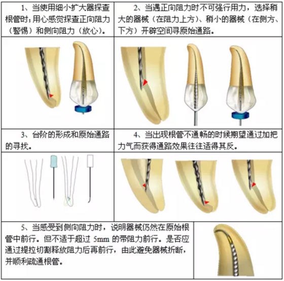 知識分享：根管治療的標準步驟