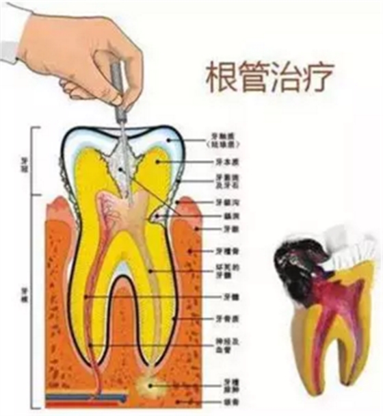 醫生，牙齒折斷不是應該補上去嗎，為啥要做根管治療？