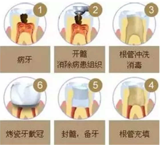 醫生，牙齒折斷不是應該補上去嗎，為啥要做根管治療？