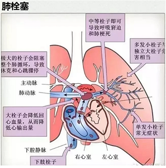 牙醫要注意！3％雙氧水口腔內沖洗致氣體栓塞