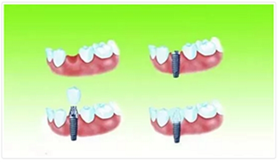 種植牙常見問答你知道多少？