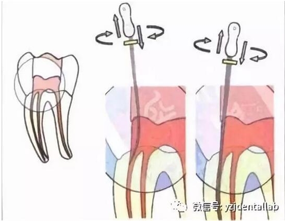 根管治療